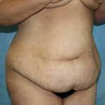 Tummy Tuck Before & After Patient #677