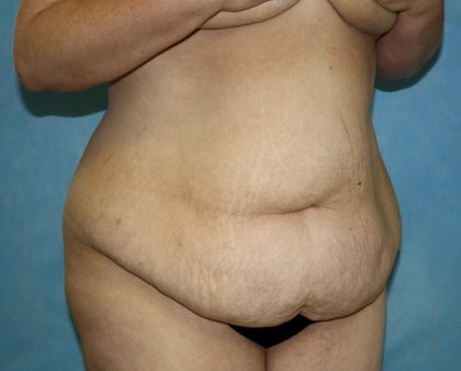 Tummy Tuck Before & After Patient #677