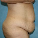 Tummy Tuck Before & After Patient #677
