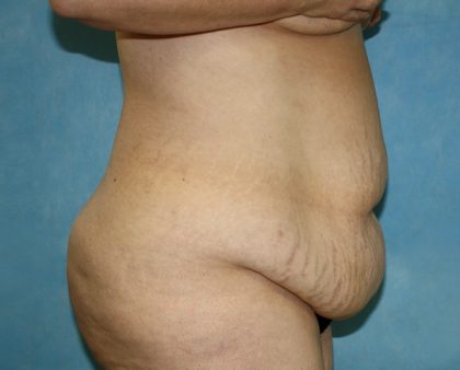 Tummy Tuck Before & After Patient #677