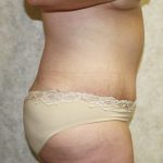 Tummy Tuck Before & After Patient #677