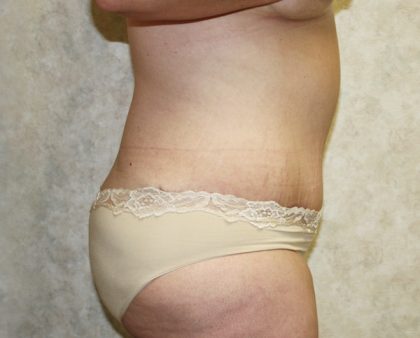 Tummy Tuck Before & After Patient #677