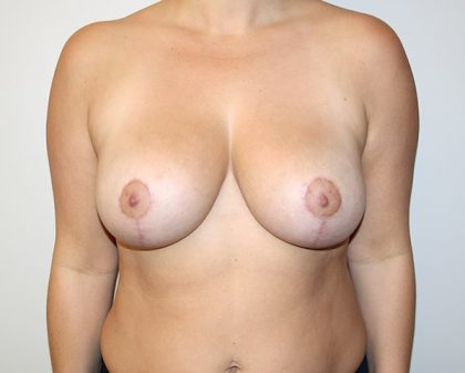 Breast Reduction Before & After Patient #891