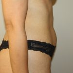 Tummy Tuck Before & After Patient #684