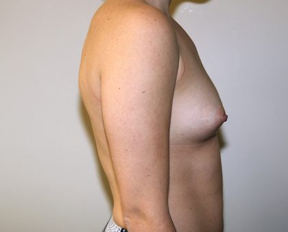 Breast Augmentation Before & After Patient #1730