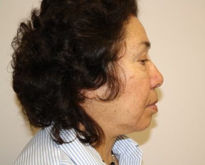 Facelift Before & After Patient #1066