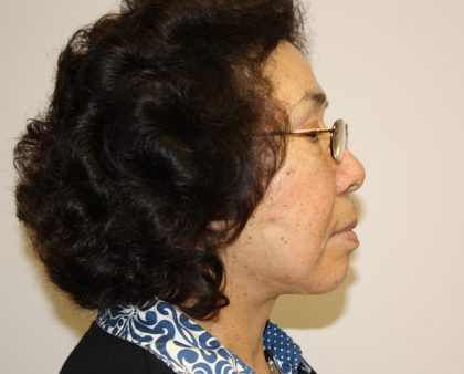 Facelift Before & After Patient #1066