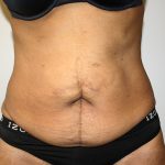 Tummy Tuck Before & After Patient #649