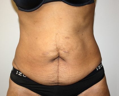 Tummy Tuck Before & After Patient #649