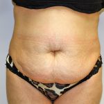 Tummy Tuck Before & After Patient #719