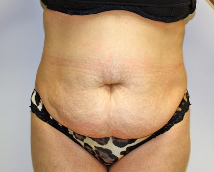 Tummy Tuck Before & After Patient #719
