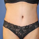 Tummy Tuck Before & After Patient #719