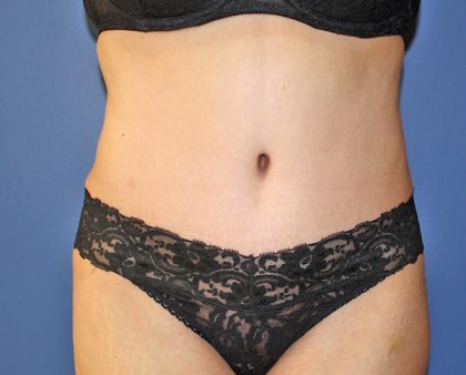 Tummy Tuck Before & After Patient #719