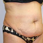 Tummy Tuck Before & After Patient #719