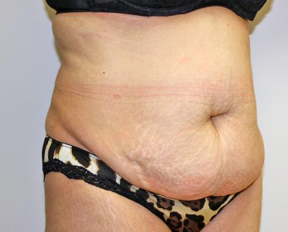 Tummy Tuck Before & After Patient #719