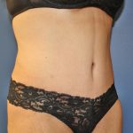 Tummy Tuck Before & After Patient #719