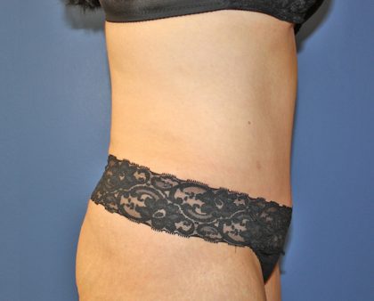 Tummy Tuck Before & After Patient #719