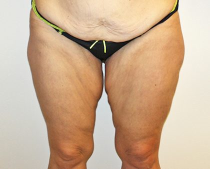 Thigh Lift Before & After Patient #1375