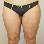 Thigh Lift Before & After Patient #1375