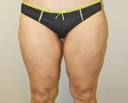 Thigh Lift Before & After Patient #1375