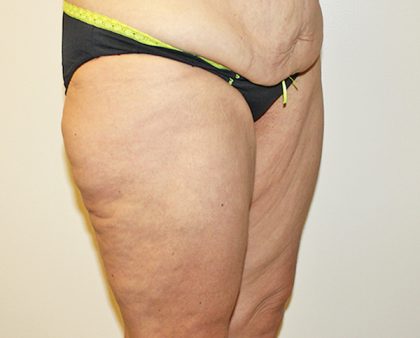 Thigh Lift Before & After Patient #1375