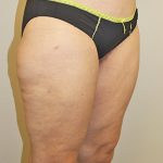 Thigh Lift Before & After Patient #1375