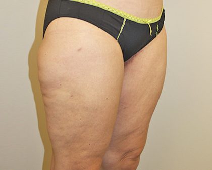 Thigh Lift Before & After Patient #1375