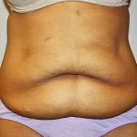 Tummy Tuck Before & After Patient #489