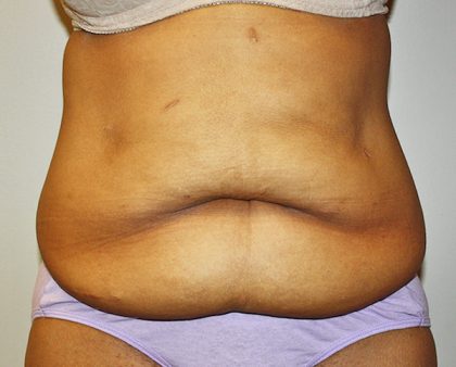 Tummy Tuck Before & After Patient #489