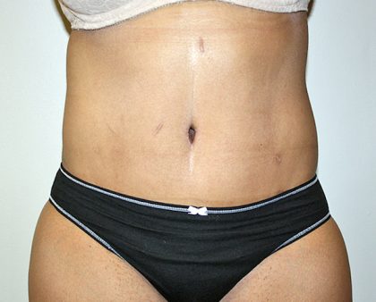 Tummy Tuck Before & After Patient #489