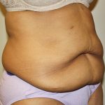 Tummy Tuck Before & After Patient #489