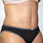 Tummy Tuck Before & After Patient #489