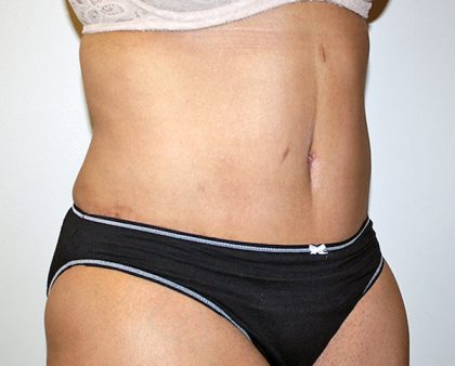 Tummy Tuck Before & After Patient #489