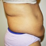 Tummy Tuck Before & After Patient #489