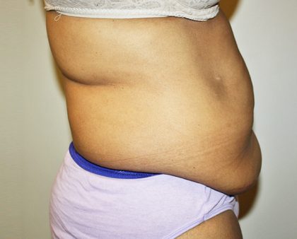 Tummy Tuck Before & After Patient #489