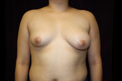 Breast Augmentation Before & After Patient #1635