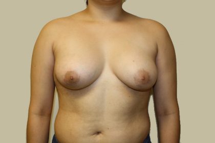 Breast Augmentation Before & After Patient #1635