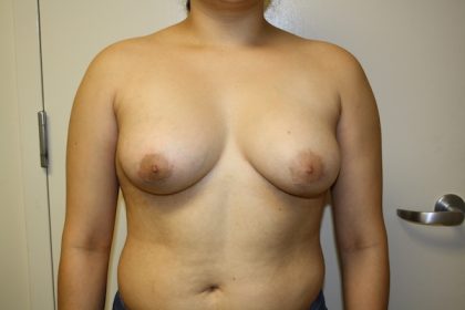 Breast Augmentation Before & After Patient #1635