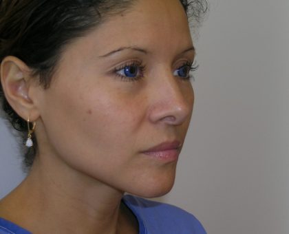 Rhinoplasty Before & After Patient #1352