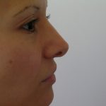 Rhinoplasty Before & After Patient #1352