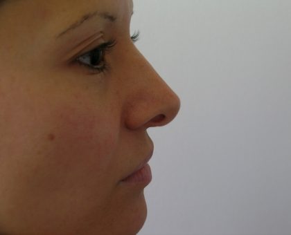 Rhinoplasty Before & After Patient #1352