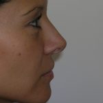 Rhinoplasty Before & After Patient #1352