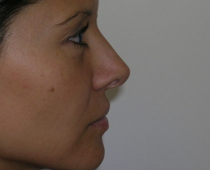 Rhinoplasty Before & After Patient #1352