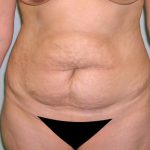 Tummy Tuck Before & After Patient #577