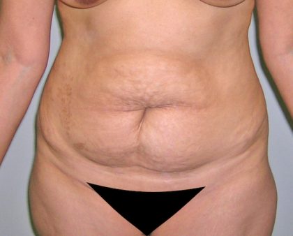 Tummy Tuck Before & After Patient #577