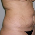 Tummy Tuck Before & After Patient #577