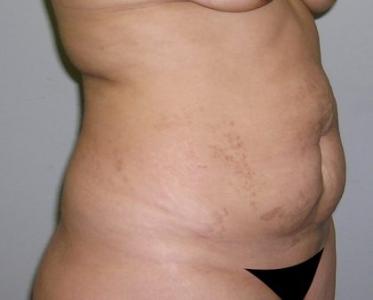 Tummy Tuck Before & After Patient #577