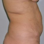 Tummy Tuck Before & After Patient #577