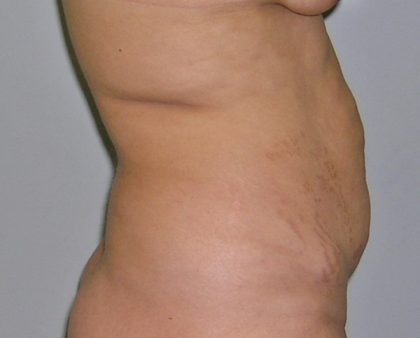 Tummy Tuck Before & After Patient #577