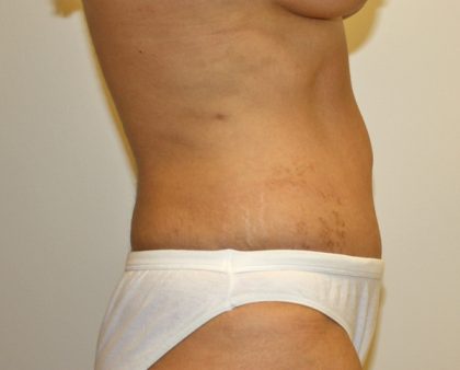 Tummy Tuck Before & After Patient #577